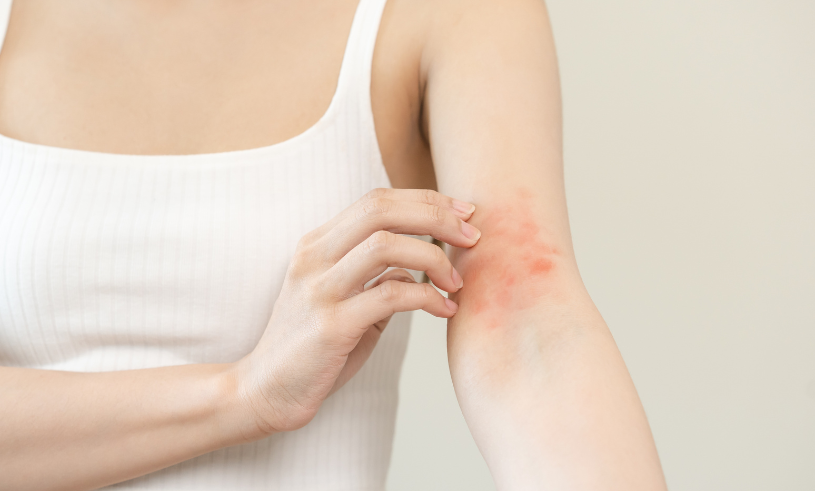 Eczema atopico – trattamenti e sintomi