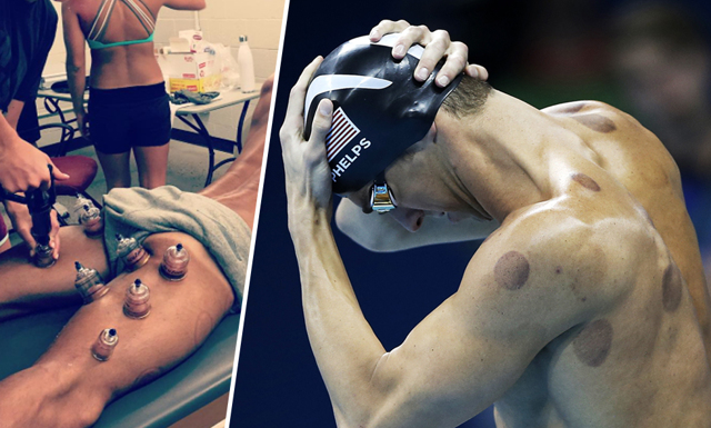 Därför använder sig Michael Phelps av koppning – vågar du testa?