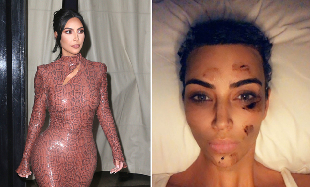 Kim Kardashian West öppnar upp och visar sin hudsjukdom: “Psoriasis är skit”