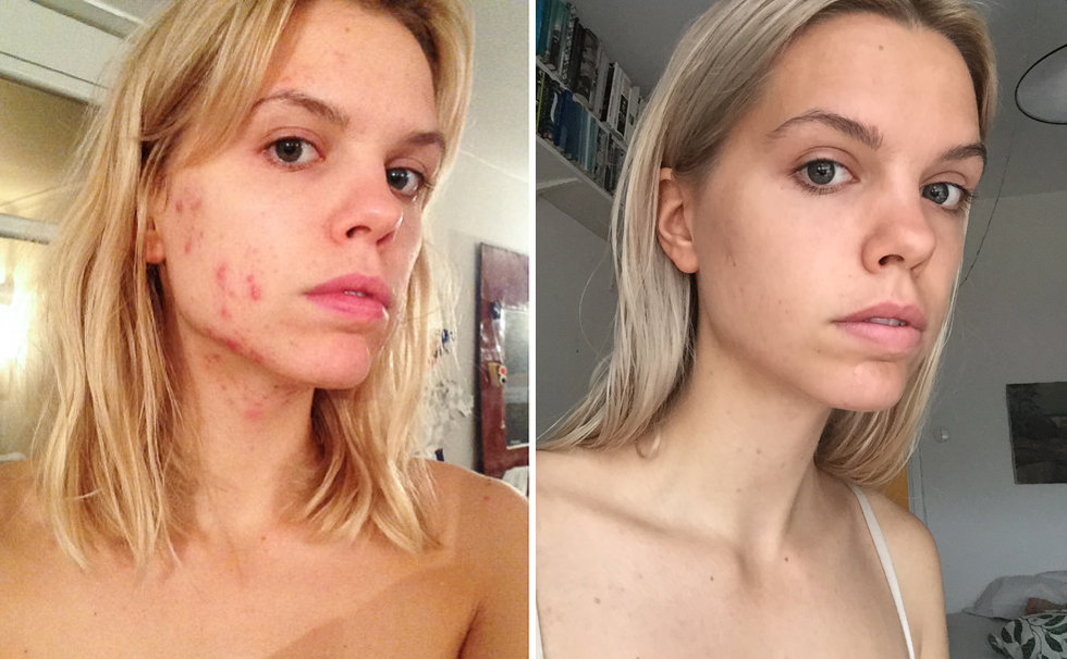 Hur man blir av med acne - florasblogg.se, @florawis